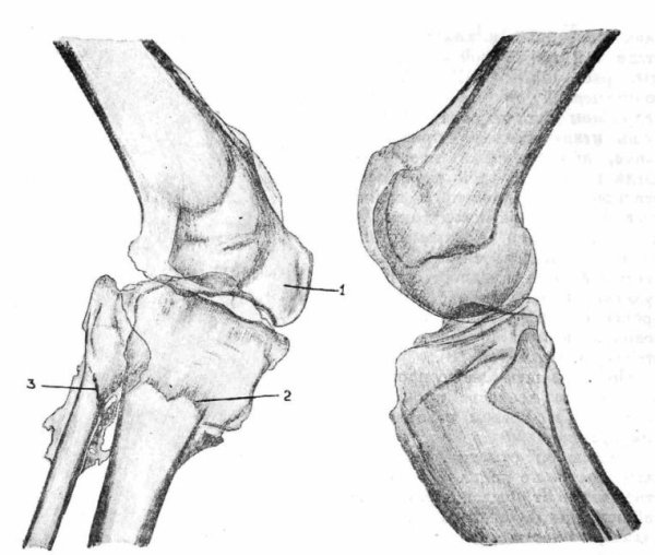 Сверхкомплектные кости коленного сустава