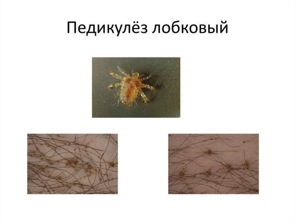 Рисунок головной вши