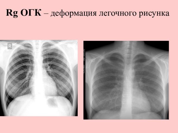 Легочный рисунок деформирован