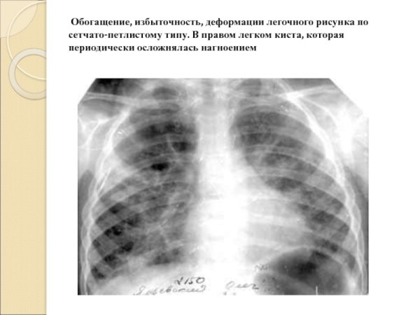Синдром деформации легочного рисунка