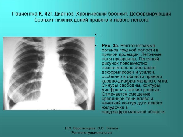 Рентген лёгких при хронической бронхите