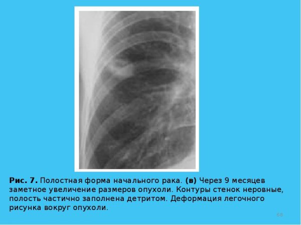 Легочный рисунок деформирован