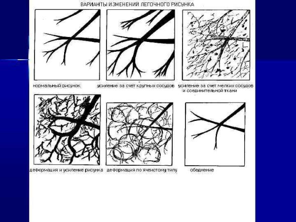 Синдром деформации легочного рисунка