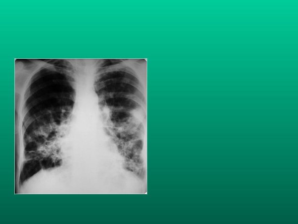 Рентгенограмма органов грудной полости в прямой проекции