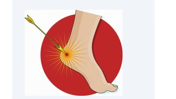 Ахиллесова пята