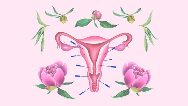 Воронко тазовая связка матки