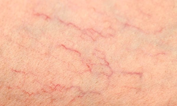 Сосудистые звездочки телеангиэктазии