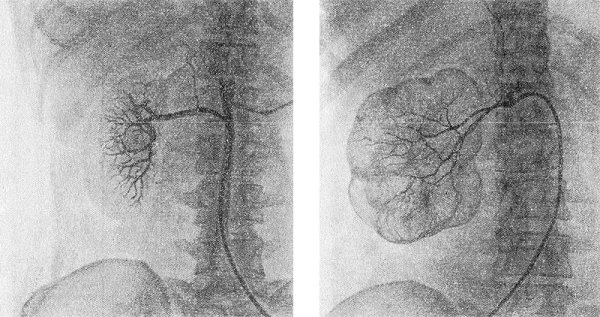 Обеднение сосудистого рисунка