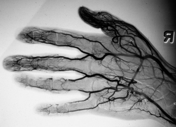 Ангиограмма сосудов верхних конечностей