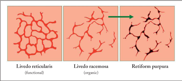 Узелковый полиартериит сыпь