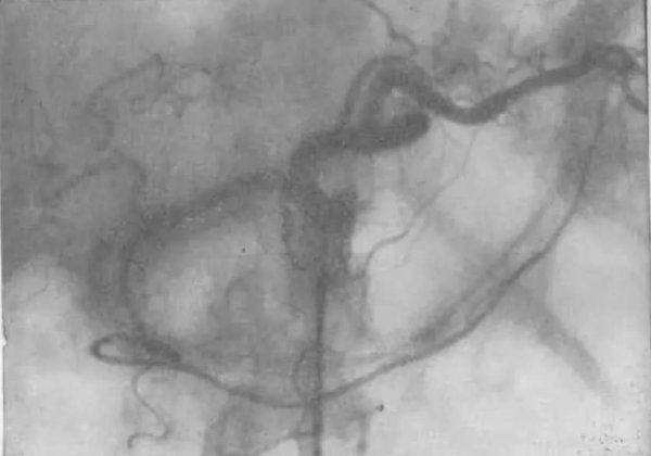 Сосудистый рисунок печени