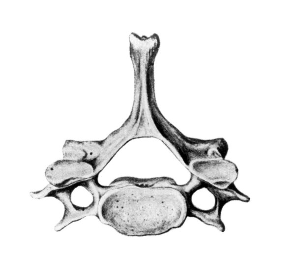 Шестой шейный позвонок Атлант