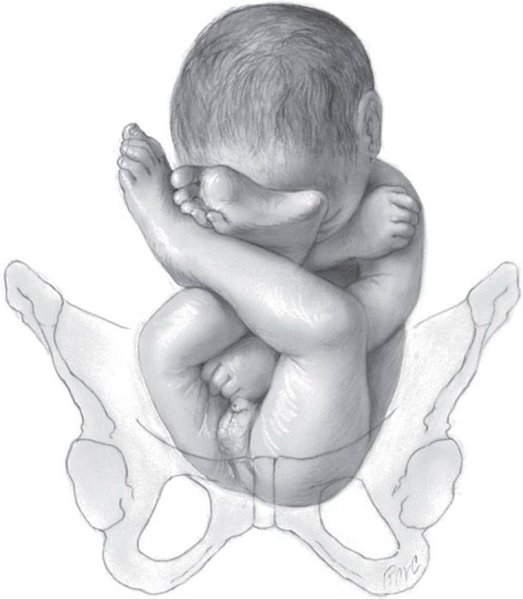 Поперечный размер плечиков плода