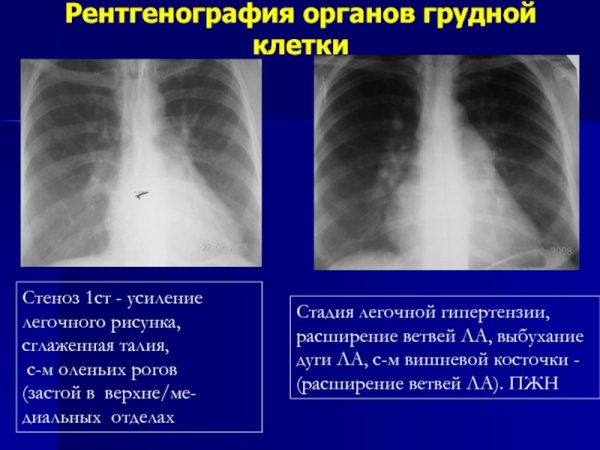 Патология легочного рисунка