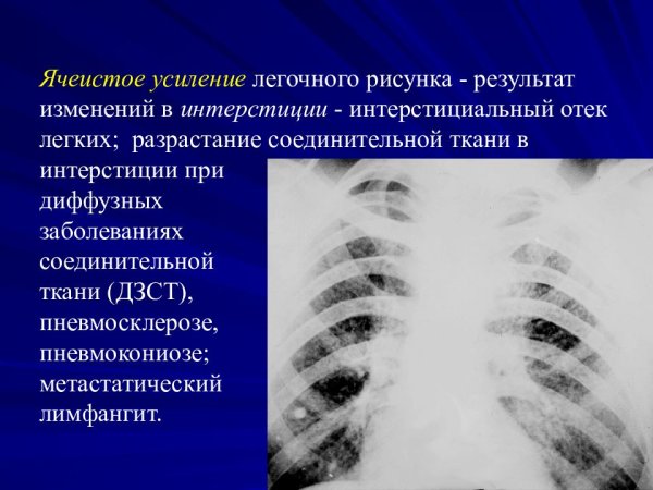 Рентгенография при хроническом бронхите описание