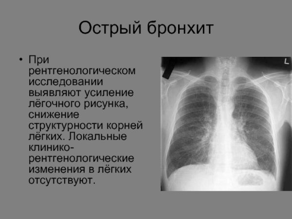 Изменение легочного рисунка