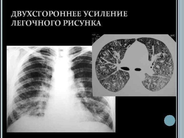 Деформация корней легочного рисунка