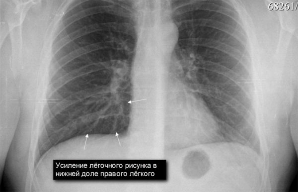 Легочный рисунок усилен