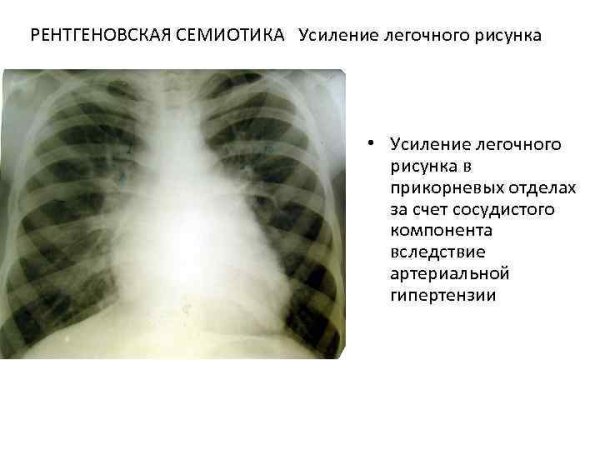 Усиление лёгочного рисунка на рентгенограмме