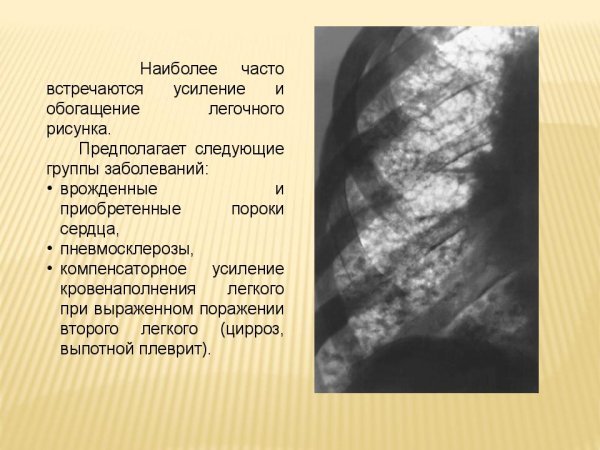 Легочный рисунок обогащен