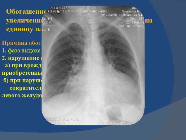 Коарктация аорты рентгенограмма