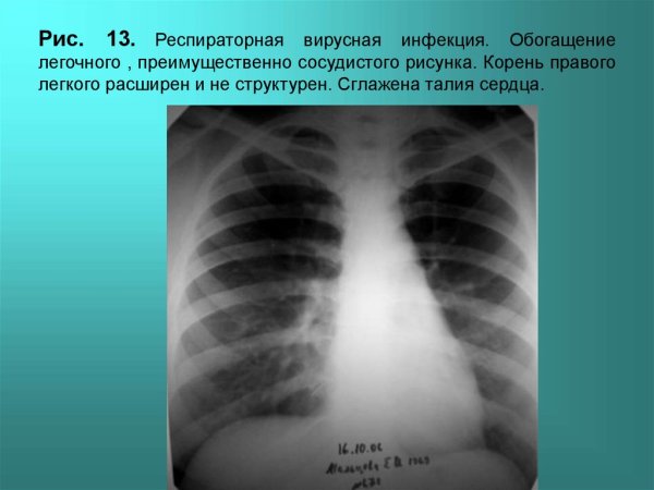Усиление и обогащение легочного рисунка