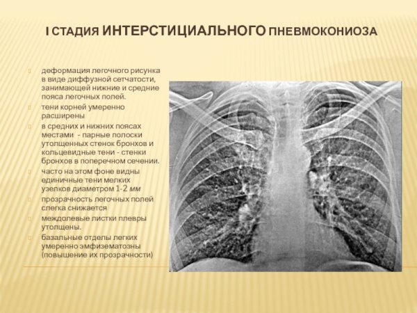 Изменение легочного рисунка