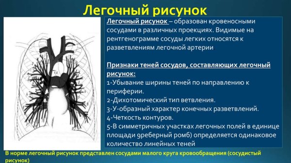 Легочный рисунок усилен