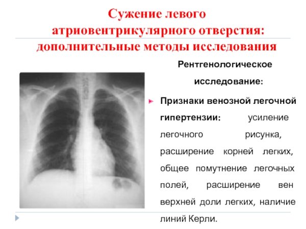Легочный рисунок в норме и патологии