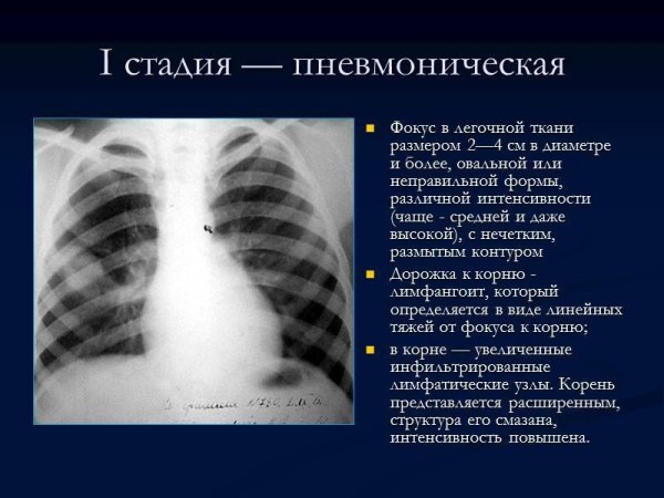 Усиленный легочный рисунок