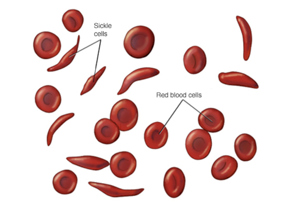 Sickle Cell anemia