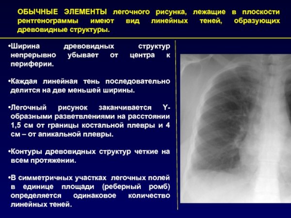 Легочной рисунок в норме на рентгене