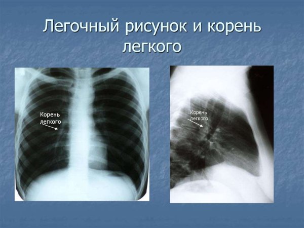 Изображение легочного рисунка