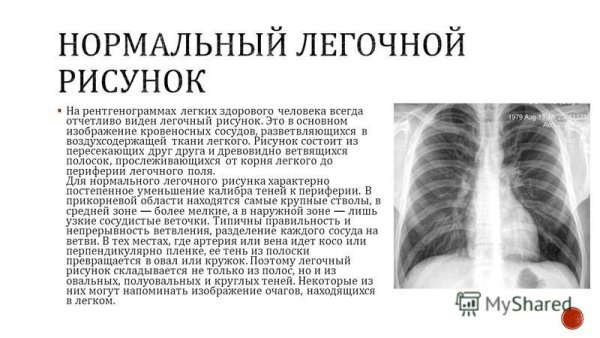 Изменение легочного рисунка