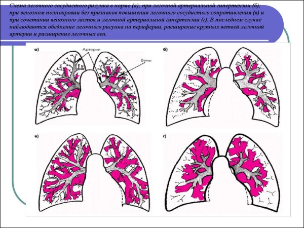 Патология легочного рисунка