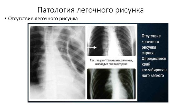 Синдром изменения легочного рисунка рентген