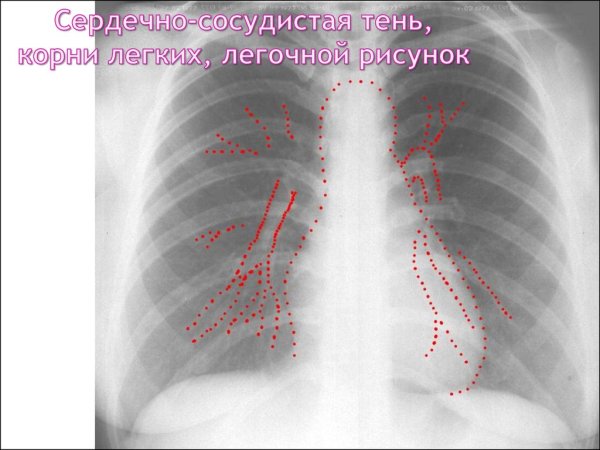 Структура корня легкого на рентгенограмме