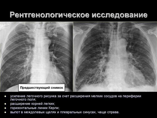 Усиление легочного рисунка