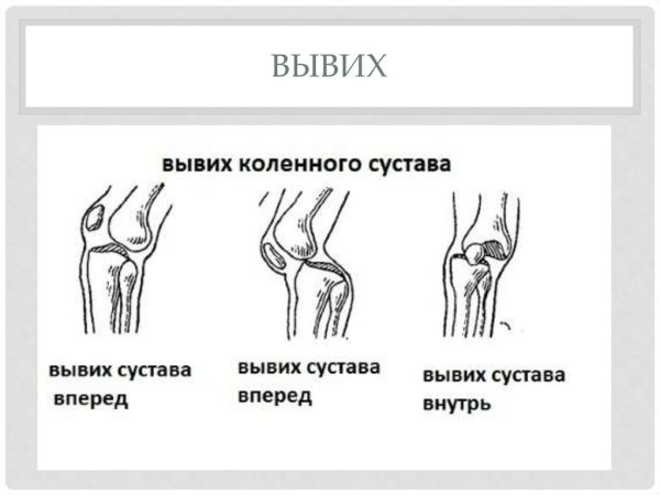 Подвывих коленного сустава схема