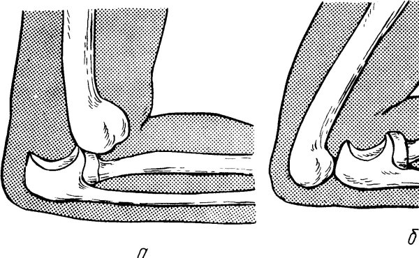 Передний вывих локтевого сустава