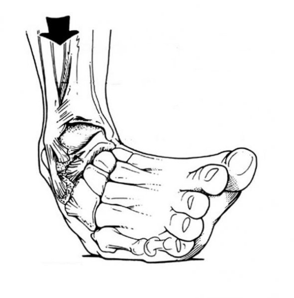 Рисунок растяжения сустава