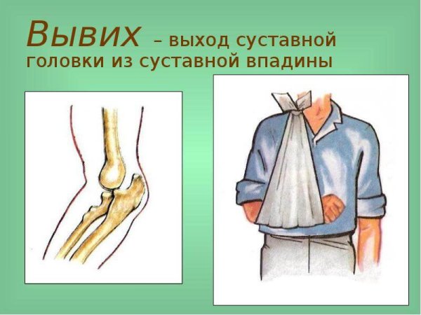 Вывих схематичный рисунок