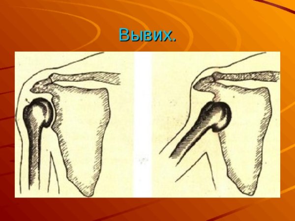 Передний и задний вывих локтевого сустава