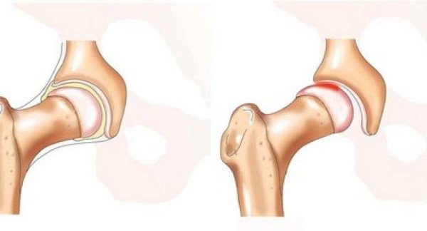 Травматический вывих локтевого сустава