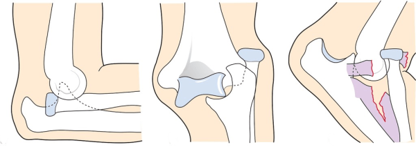Закрытый вывих головки левой плечевой кости