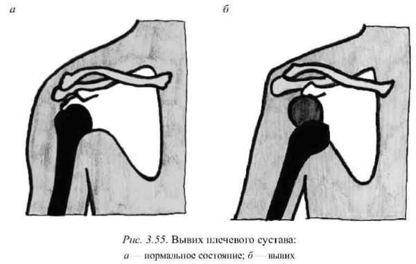 Травмы при падении вперед