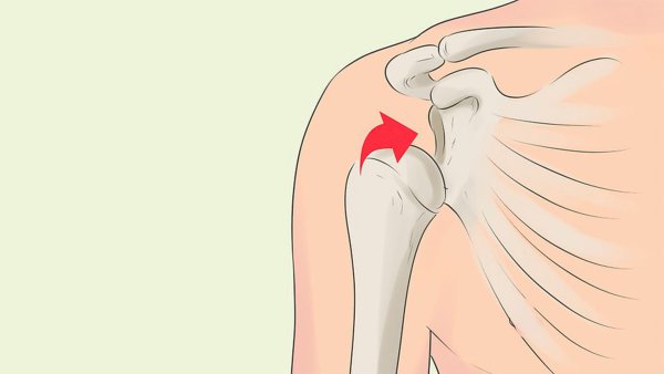 ПМП при вывихах и растяжениях связок