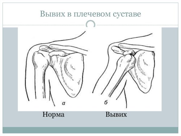 При переломе предплечья