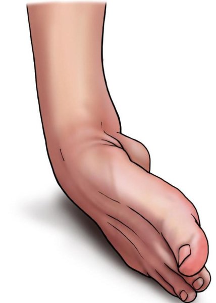 Вывих конечности первая помощь