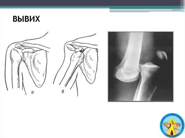 Вилкообразная деформация кисти